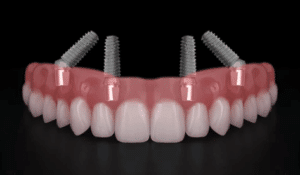 garanzia su impianti dentali